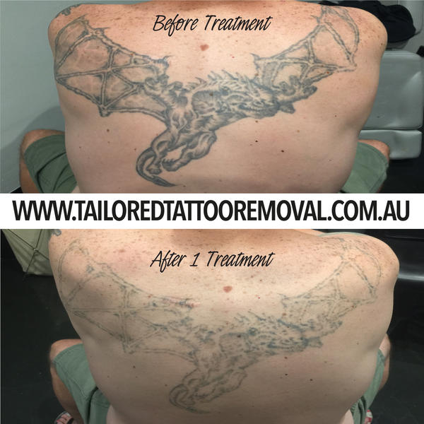Tailored Tattoo Removal