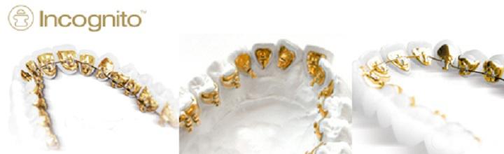 Supersmile Orhtodontist: Canberra