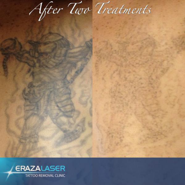 Eraza Laser Tattoo Removal Clinic: Townsville