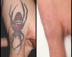 DRM Laser Tattoo Removal