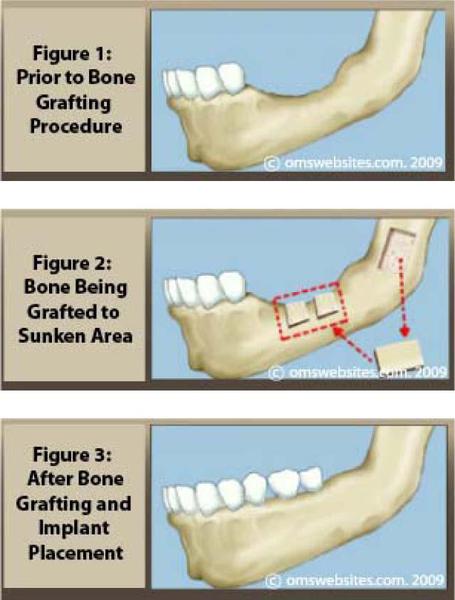 Surgident - Dental Implants Melbourne