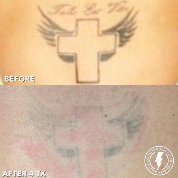 The Tattoo Removal Co