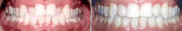 Class 1 Orthodontics: Canning Vale