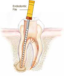 Laser Root Canal