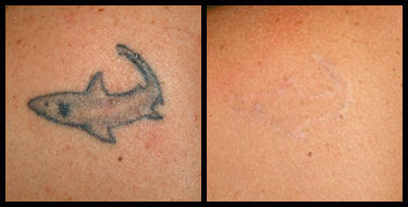 A1 Vanquish Tattoo Removal