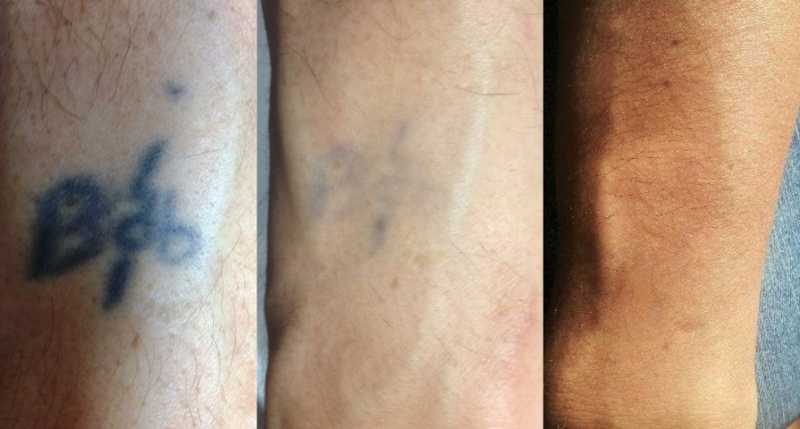 Edit Tattoo Removal