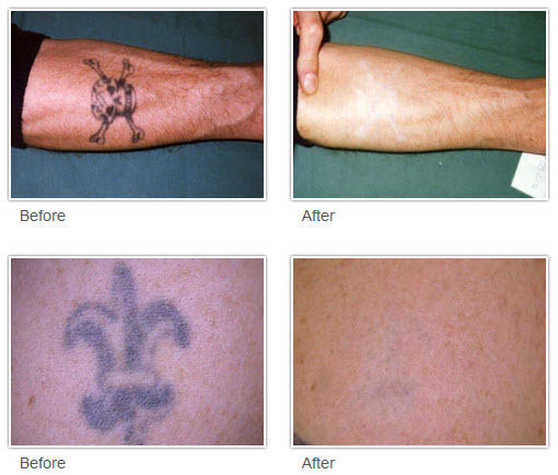 Tattoo Removal Laser Clinics