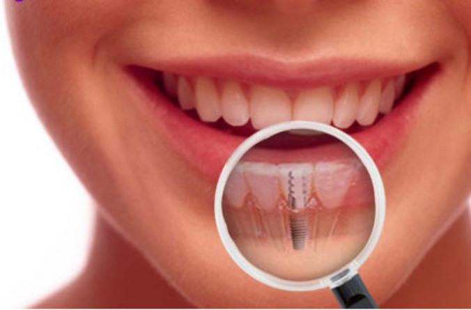 Shire Dental Implant
