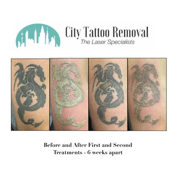 City Tattoo Removal