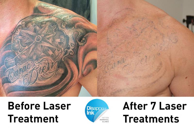 Disappear Ink Tattoo Removal Clinic