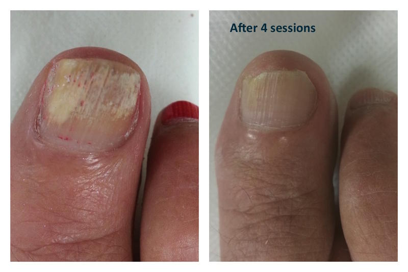 Back to Blank Laser Tattoo Removal