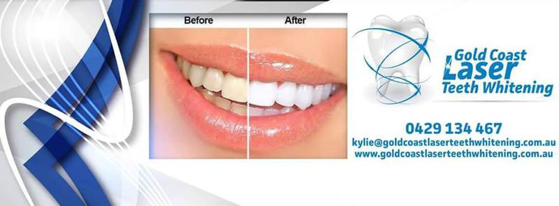 Gold Coast Laser Teeth Whitening