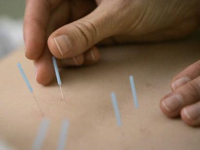BMBS Acupuncture: Wavell Heights