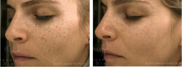 Pigmentation Care by Sia: Castle Hill