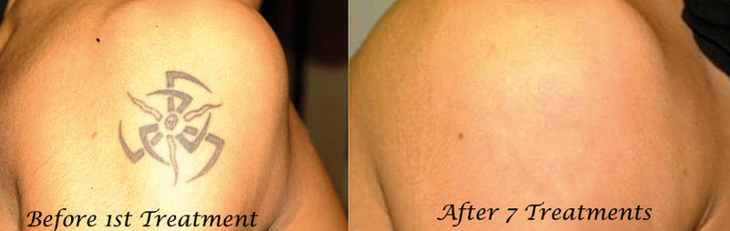 Universal Tattoo Removal