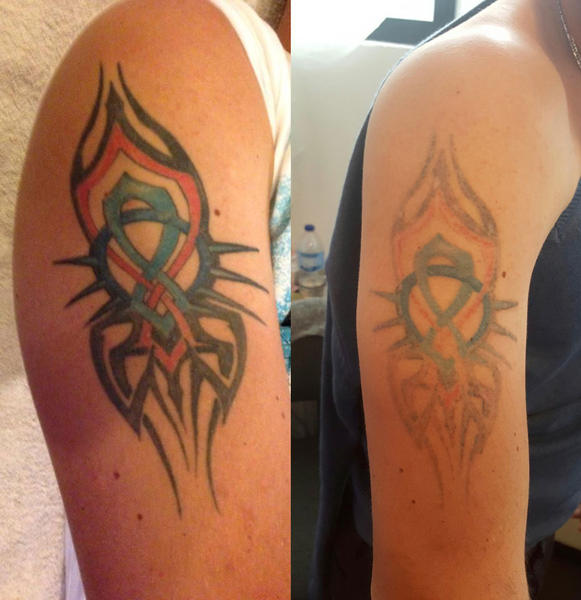 No Regrets Laser Tattoo Removal