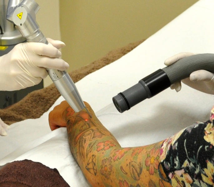 Laser Tattoo Removal Brisbane