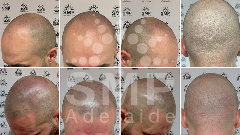 Scalp MicroPigmentation Adelaide: Walkerville