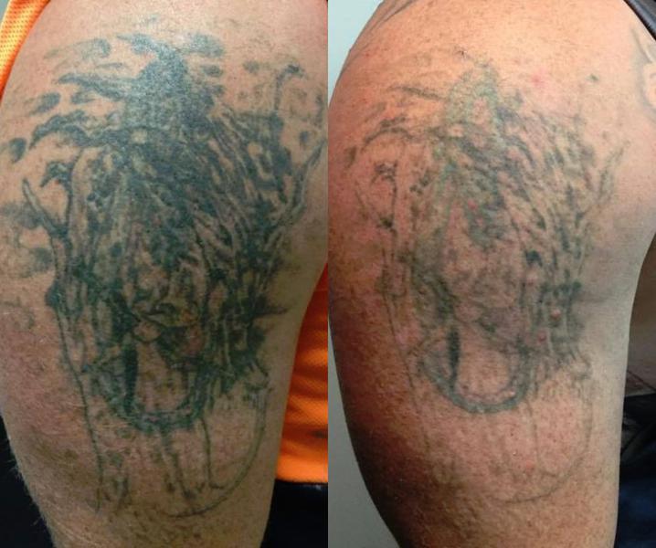 Extinkt Tattoo Removal Specialists