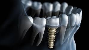 Nepean Dental Implants