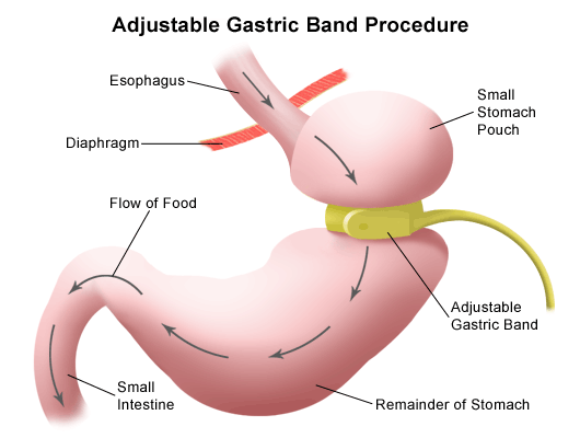 Virtual Gastric Band Hypnosis