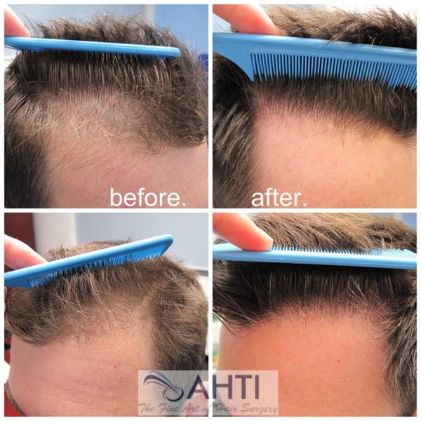 Australasian Hair Transplant Institute: Chatswood