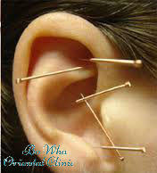 Acupuncture Brisbane: Sunnybank