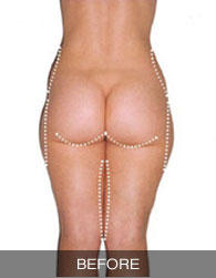 Ultrasonic Slimming