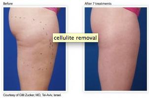 Cellulite Treatments by Sia: Sydney