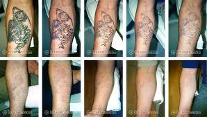Tattoo Removal Western Australia