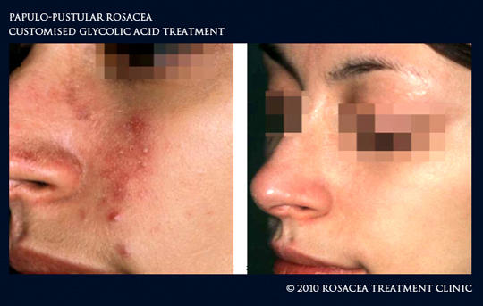 Rosacea Treatment Clinic: Port Melbourne